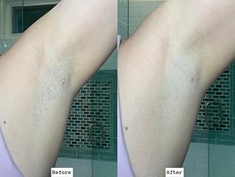 IPL Hair Removal
