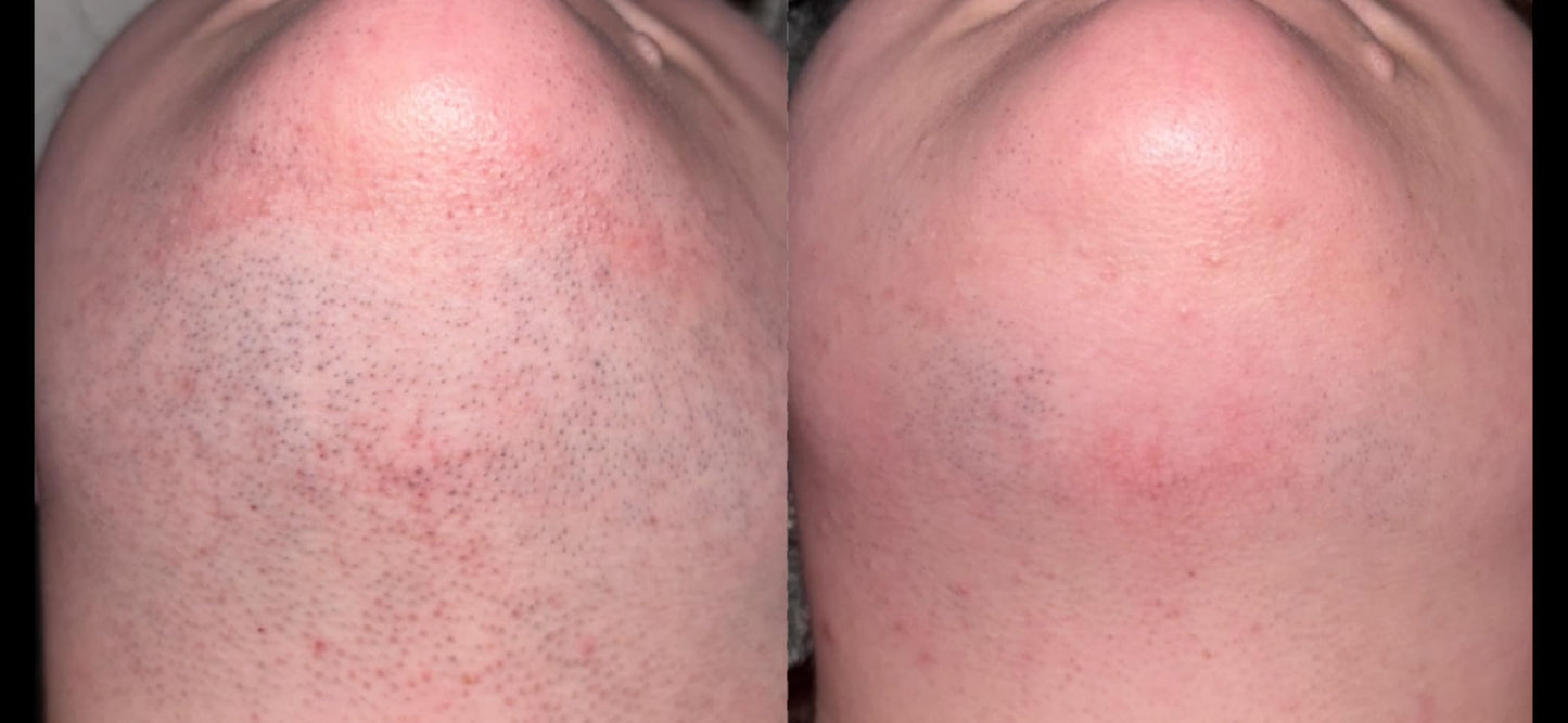 IPL Hair Removal