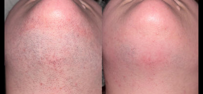 IPL Hair Removal