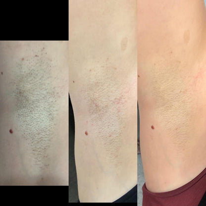 IPL Hair Removal
